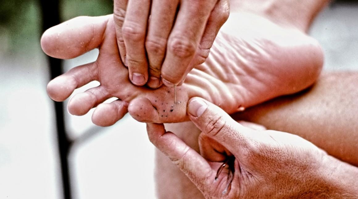 ¿Cómo sacar las púas de erizo de mar?